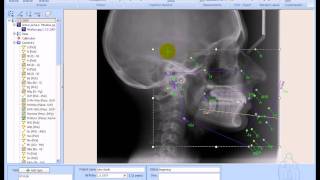 AxCEPH Cephalometric Analysis [upl. by Suryt454]