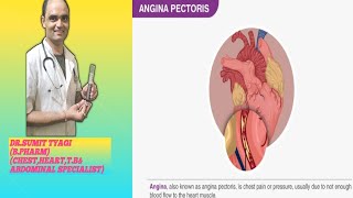 CHRONIC ANGINA PACTOTARIS [upl. by Giorgi]