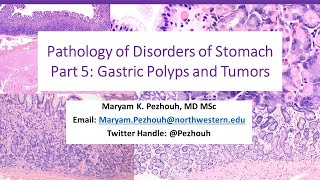 Part 5 Pathology of Gastric Disorders polyps and Tumors [upl. by Markiv]