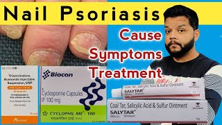 नाखून मे होने वाला सोरायसिस कारण लक्षण और उपचार  Nail Psoriasis Causes Symptoms amp Treatment [upl. by Joli]