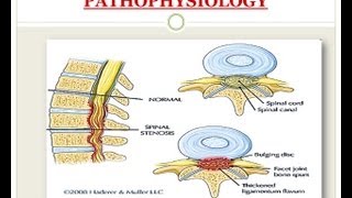 Spinal Stenosis  Medical PowerPoint Presentation [upl. by Aret]