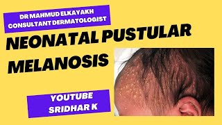 Neonatal pustular melanosisa dermatologists perspective rash newbornrash pustularmelanosis [upl. by Neelyad394]