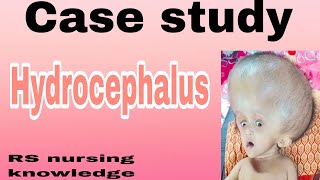 Case study on hydrocephalus Case book Hydrocephalus ncp Care plan on Hydrocephalus hydrocephalus [upl. by Ariaj639]