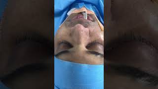 Radix and alar base reduction nose contouring surgery [upl. by Annenn]