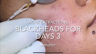 Blackheads for days part 3 15 minutes of just the pop Extractions Blackheads whiteheads milia [upl. by Iznik]