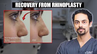 What is the recovery after rhinoplasty nose reshaping surgery The truth revealed [upl. by Yerkovich]