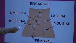 Types of Hernia [upl. by Koblick843]