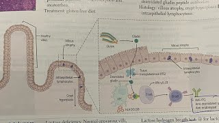 Malabsorption syndrome Celiac  whipple  Hindi neetpg inicet neetpgprep firstaidusmle [upl. by Mountford283]