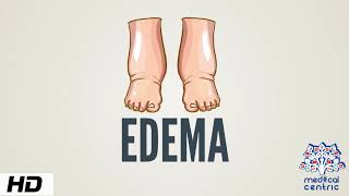 Edema Causes Signs and Symptoms Diagnosis and Treatment [upl. by Attekram]