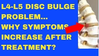 Why Does L4 L5 Disc Bulge Symptom Increase After Treatment  Answered by Chiropractor in Vaughan [upl. by Anilocin971]