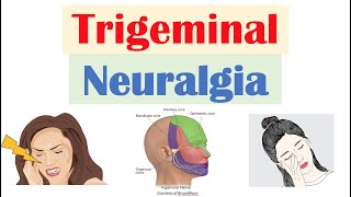 Trigeminal Neuralgia “Severe Facial Pain” Causes Pathophysiology Symptoms Diagnosis Treatment [upl. by Fiden]