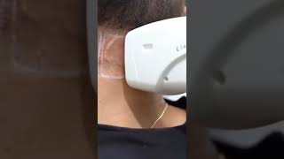 Laser Hair Removal Treatment by Dr Adil Hamayun [upl. by Dnalyram]