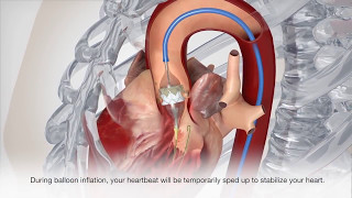 Cardiac Catheterization  Patient Treatment [upl. by Marguerita72]