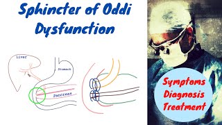 Sphincter of Oddi Dysfunction Made Easy to understand [upl. by Babette]