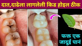 घरातील फक्त 2 वस्तू वापरा दातांन संबंधित सर्व समस्या दूर होतील😱 kitchen tips  teeth  home remedies [upl. by Darahs]