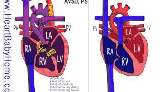 25  Total Anomalous Pulmonary Vein Return TAPVR with DORV AVSD ps [upl. by Squires]