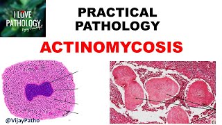 Practical Pathology ACTINOMYCOSIS [upl. by Idrahs922]