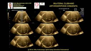 Arthrogryposis congenita 23 weeks [upl. by Crespo]