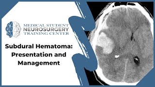 Subdural Hematoma Presentation and Management [upl. by Iams]