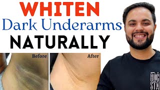 5 Natural Ways to Whiten Dark Underarms at Home in 7 Days [upl. by Bronny569]