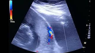 ultrasound of placenta accreta [upl. by Aital941]