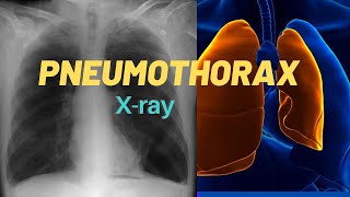 How to identify Pneumothorax in Chest Xray [upl. by Batsheva521]