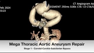 Mega Thoracic Aortic Aneurysm Repair  Stage 1 CarotidCarotidSubclavian Bypass [upl. by Shawna]