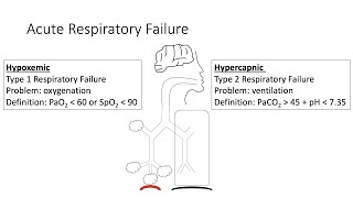 Acute Respiratory Failure [upl. by Lledyr]