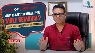 What is the Best Treatment for Mole Removal  Mole removal in Delhi  Mole removal by Laser [upl. by Jordans]