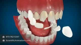 Cosmetic Dentistry Procedures  Dental Animation [upl. by Barden]