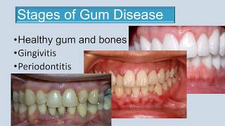 Stages of gum disease final edit 3 [upl. by Aisa]