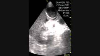 VSCAN Cholecystitis pocket ultrasound Colecistitis aguda eco de bolsillo [upl. by Aikemot]