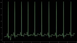 Electrocardiogramme ECG avec extrasystole avec son 1 minute [upl. by Hippel248]