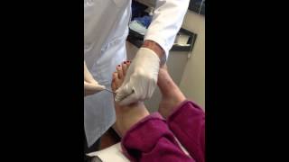 5th Metatarsal Pin Removal [upl. by Yenruogis]