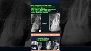 Necrotic upper first molar with Distal Caries الكربولة endodontics [upl. by Caundra]