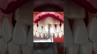 Frontal Crown Lengthening Dental Procedure [upl. by Thunell279]