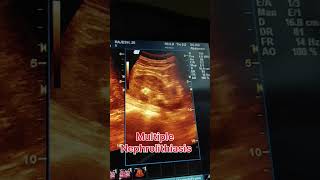 Multiple nephrolithiasis ultrasound showing video  kidney stones ultrasound ultrasound pregnant [upl. by Elletnuahs]