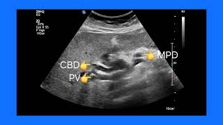 Understanding NET Pancreas MPD and Bile Duct Dilation Ultrasound amp color Doppler imaging [upl. by Pippo218]