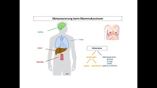 Metastasierung beim Mammakarzinom  Strahlentherapie Prof Hilke Vorwerk [upl. by Atekahs]