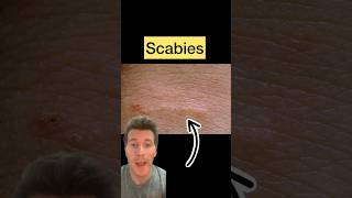 Doctor explains SCABIES in 60 seconds  causes symptoms treatment shorts scabies health [upl. by Ydnar]