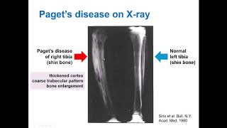 What is Paget’s Disease of Bone and how does bisphosphonate treatment work Dr Daroszewska explains [upl. by Salamanca264]