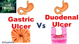 Peptic Ulcer Disease GASTRIC VS DUODENAL ULCERS [upl. by Amaerd323]