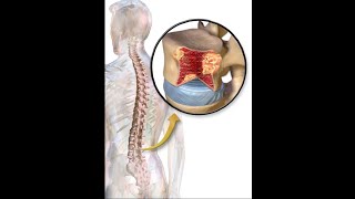 multiple bony lytic lesions [upl. by Elam]