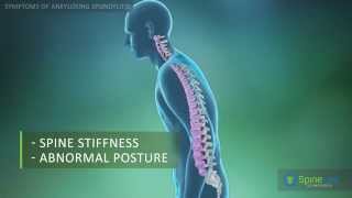 Ankylosing Spondylitis Symptoms [upl. by Eitsyrc216]