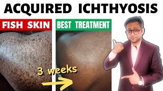 Acquired ichthyosis  Fish skin  Treatment  Hindi [upl. by Sane464]