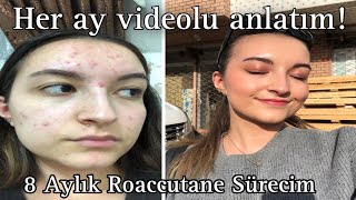 SİVİLCE TEDAVİM  Her Ay Videosunu Çektiğim 8 Aylık Roaccutane Sürecim [upl. by Elissa]