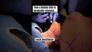 How to get rid of a double chin Austin Chin Lipo [upl. by Aleik851]