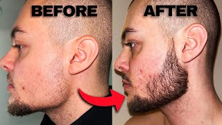 Minoxidil Beard Before And After  2 Months Progress [upl. by Rudolph]