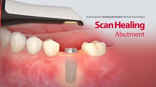 Able to scans the healing abutment without removing it  “Scan Healing Abutment” [upl. by Adian]