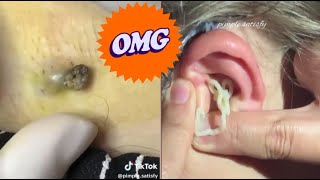 Blackhead Popping Extravaganza Satisfying Skin Care Moments [upl. by Miah]